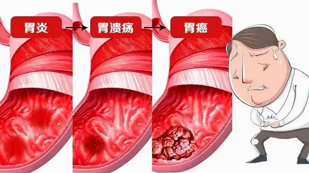 得了胃出血后喝酒能得胃癌吗,喝酒出血了是胃癌吗