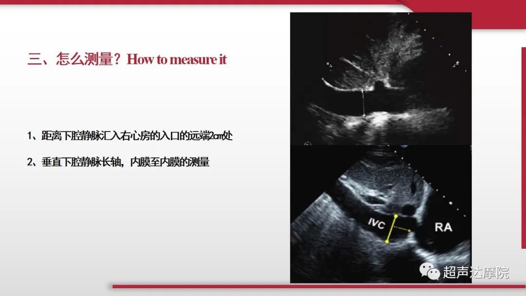 超声ppt课件大全,下腔静脉彩超评估容量