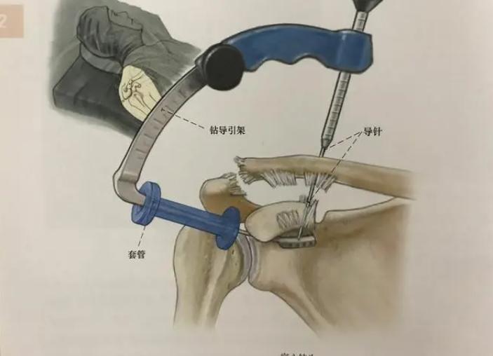 肩锁关节脱位手术多久能干体力活,左肩锁关节脱位拆钢板后多久恢复