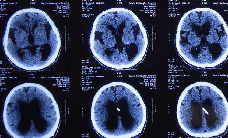 老人脑萎缩怎么办教你一招恢复,老年人脑萎缩最有效的方法