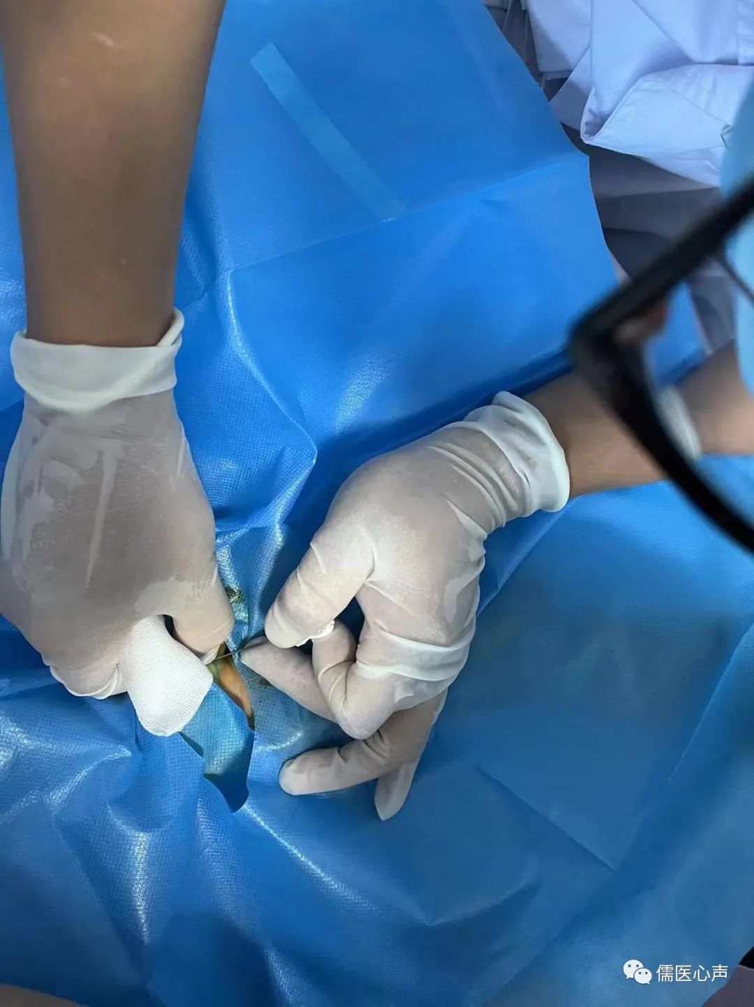 女童大拇指不能伸直,女宝三岁大拇指伸不直用做手术吗