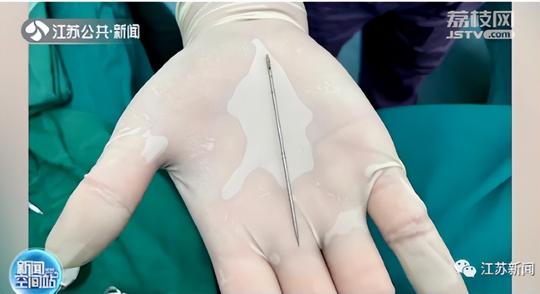 浙江14岁男孩体内取出19颗磁力珠,十一岁男孩吞磁珠