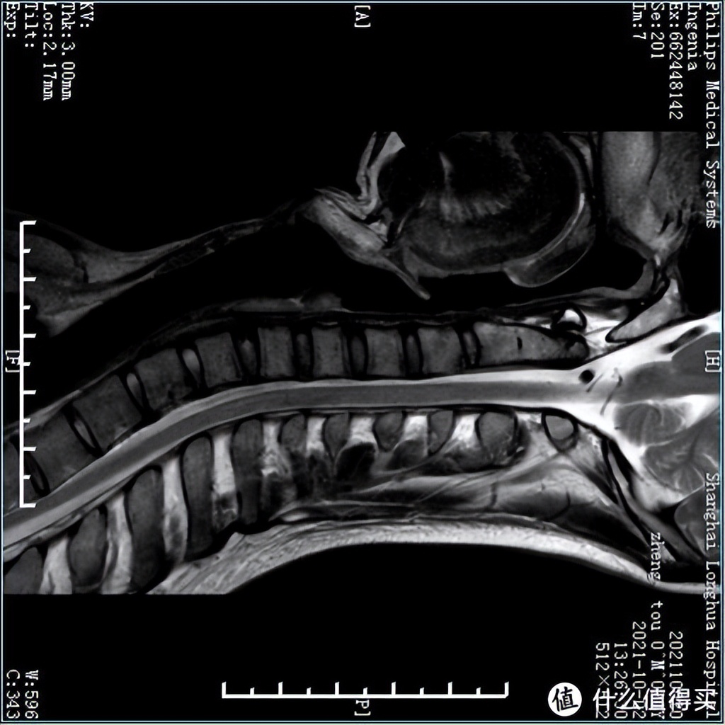 颈椎病睡记忆枕管用吗 (记忆枕对颈椎病有效)