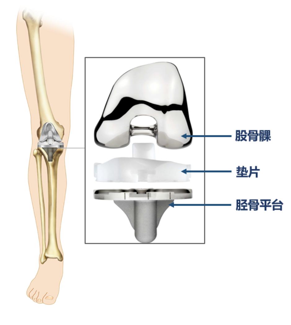 通过实例带你了解膝关节置换手术,医生为什么建议做全膝关节置换术