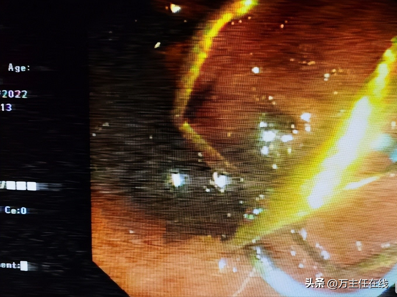 胆结石化脓性胆囊炎,妙手神针巧治疑难杂症