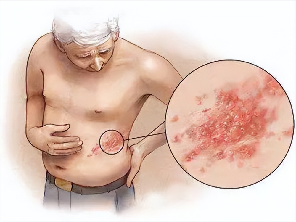 带状疱疹与水痘,带状疱疹与水痘最明显的区别