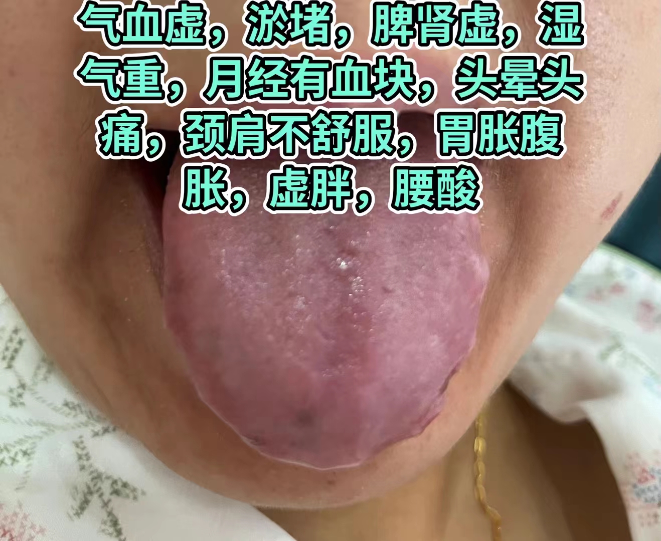 今日舌诊,舌尖舌根凹陷中医辨证