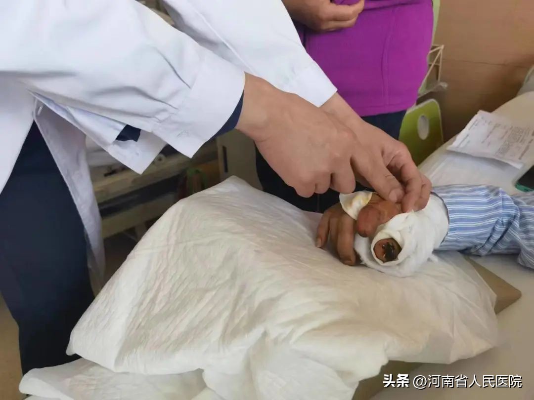 手指缺一大截！“武功加持”的医生，放大招了
