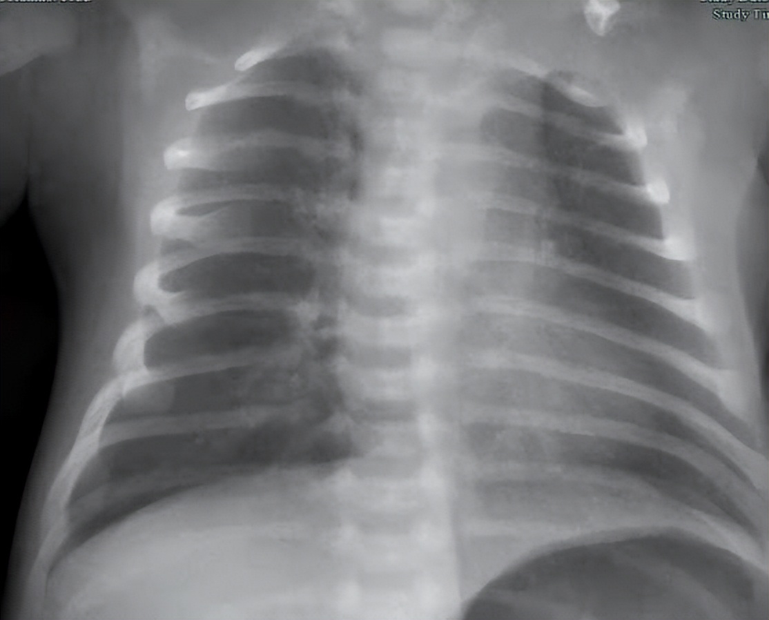 28天的新生儿肺炎的症状和表现,13天新生儿肺炎的症状和表现