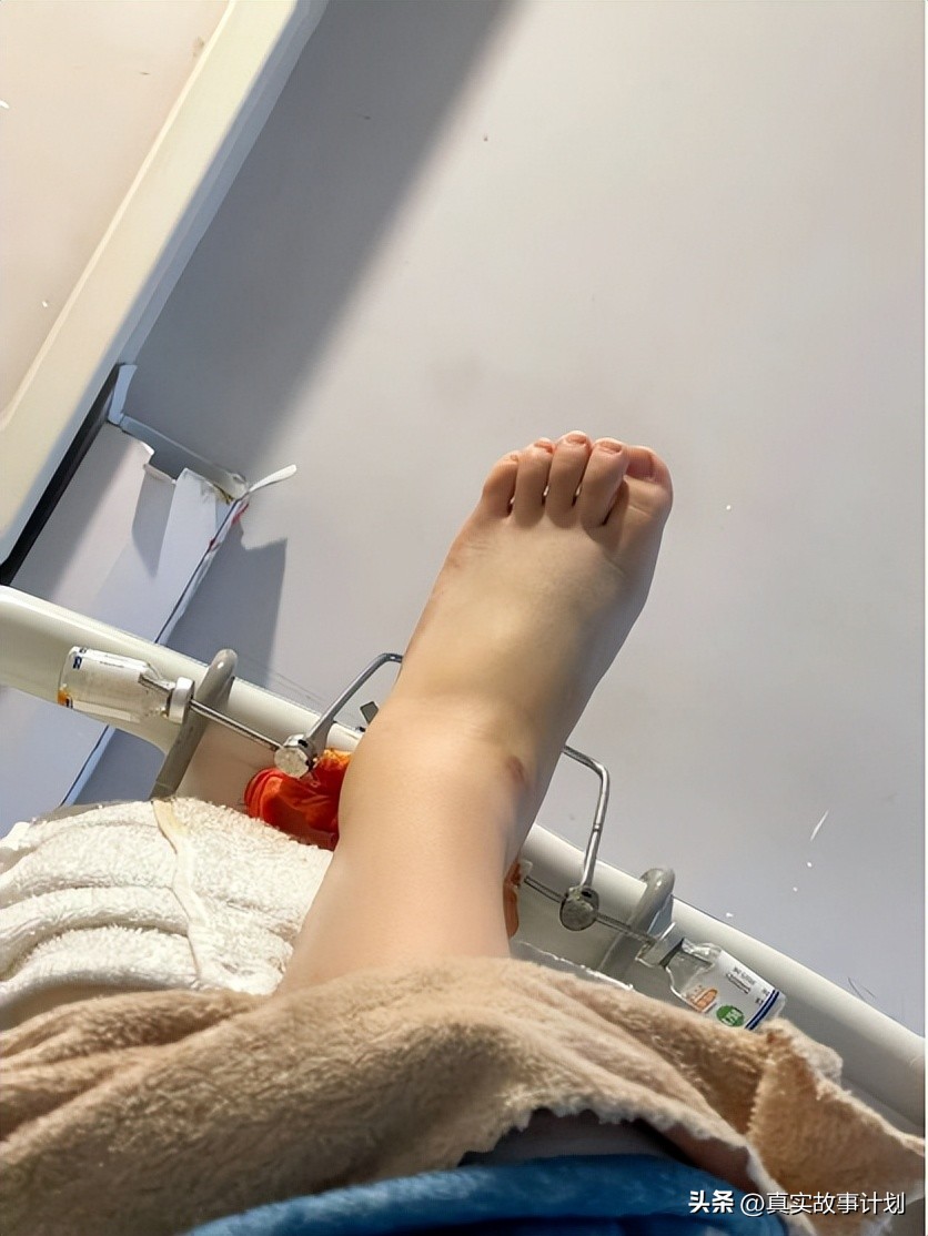 骨牵引护理手术,骨牵引的手术指征