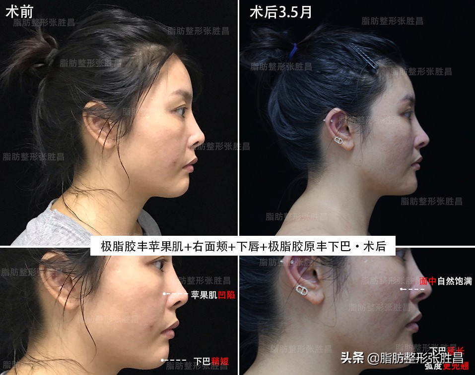 自体脂肪填充丰胸缺点,自身脂肪填充脸部有什么缺点