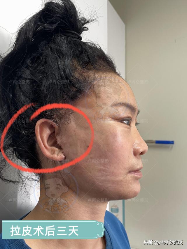 电波拉皮眼部除皱有后遗症吗,做拉皮除皱有风险吗