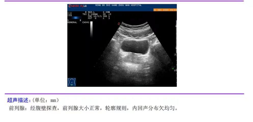 前列腺炎用痔疮栓有效吗,前列腺炎用痔疮栓