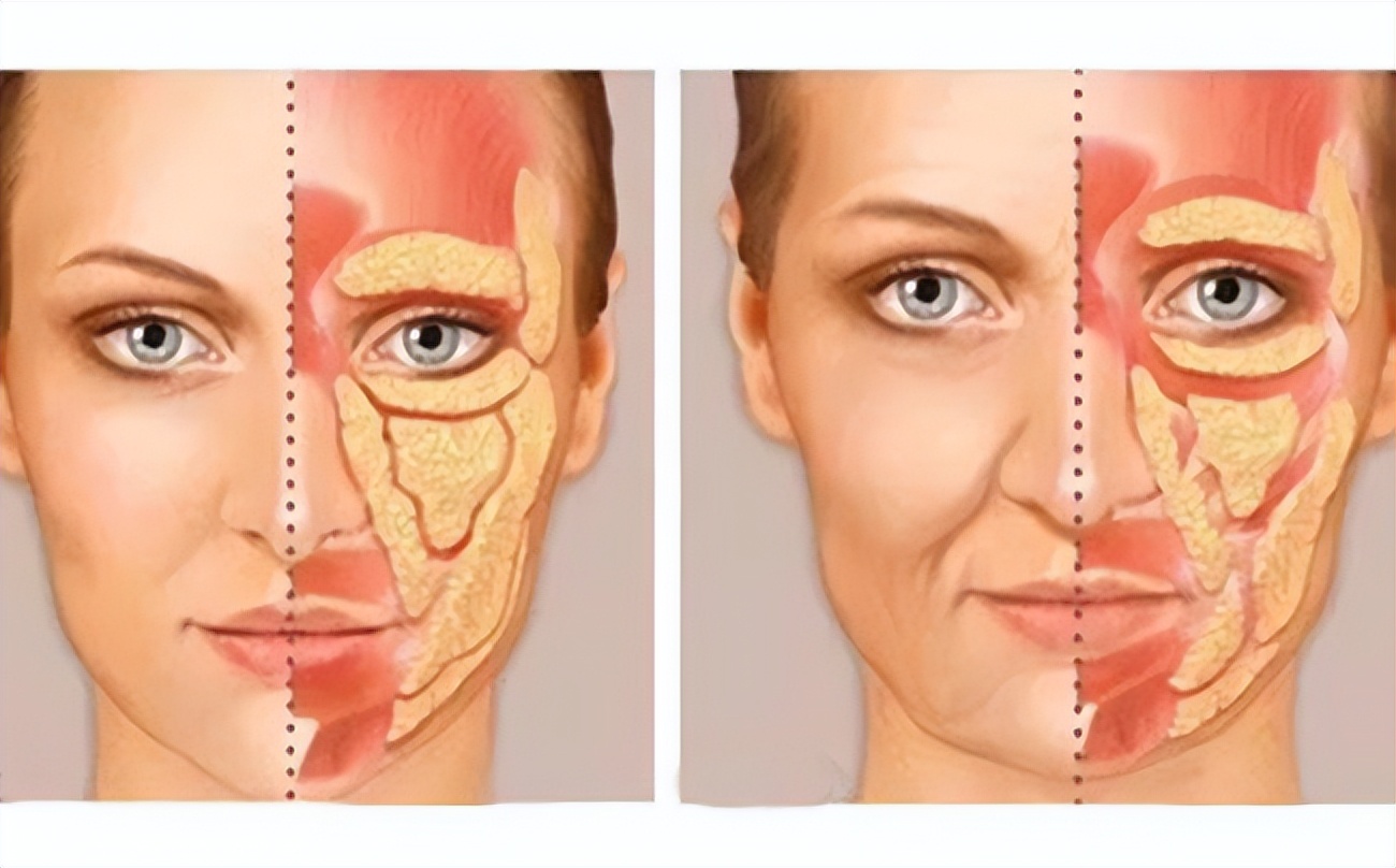 法令纹最好有效的去除方法,有法令纹最好的解决办法真实有效
