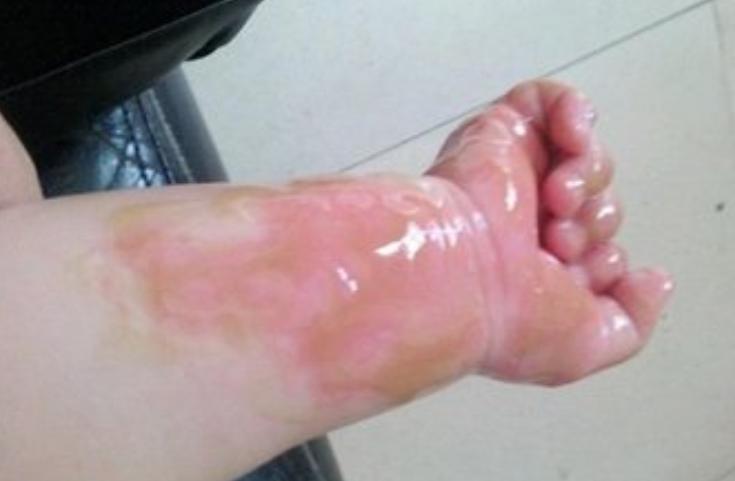 小孩被开水烫伤怎么办最快最有效,小孩被开水烫伤怎么处理最好恢复