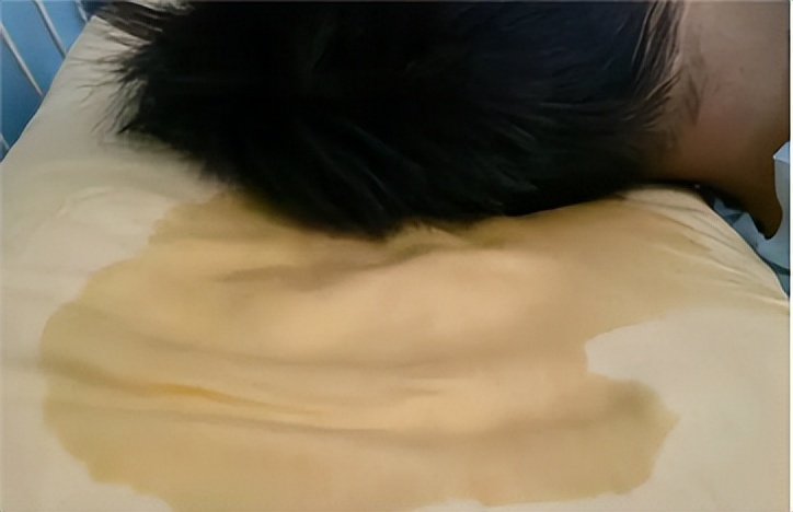 睡觉头出汗枕头湿了吃什么药,头汗多怕热怎么治