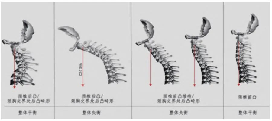 颈椎后弓畸形怎么办,颈椎后凸畸形是怎么形成的