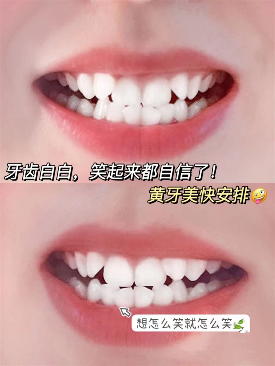 牙齿发黄牙缝大怎么去除,牙齿表面发黑如何处理呢