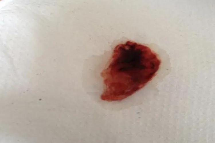 胃出血能活多久,胃出血吃什么药有效