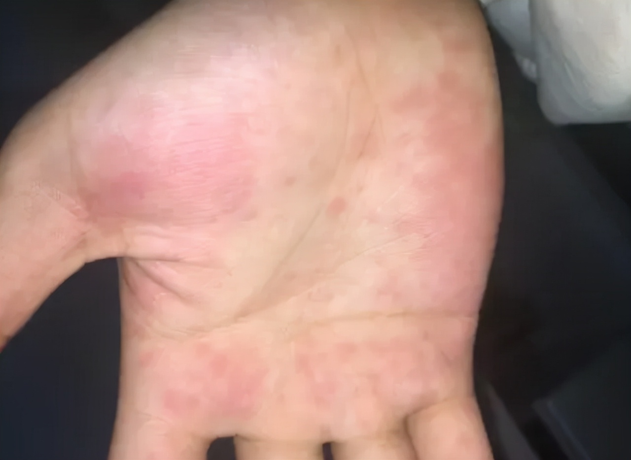 如果皮肤出现这些症状，及早做检查