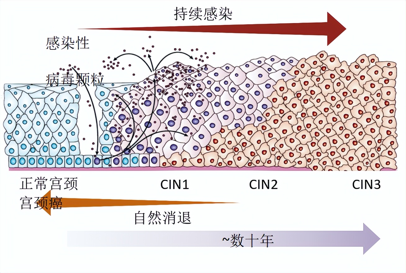 子宫颈鳞状上皮内病变诊断方法,子宫低级别鳞状上皮内病变治疗