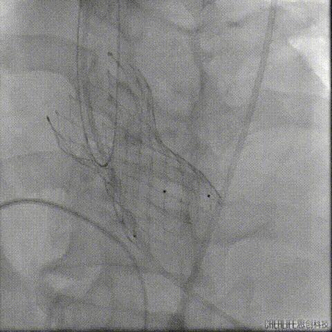 病例回顾与分享,腹膜后血肿介入治疗