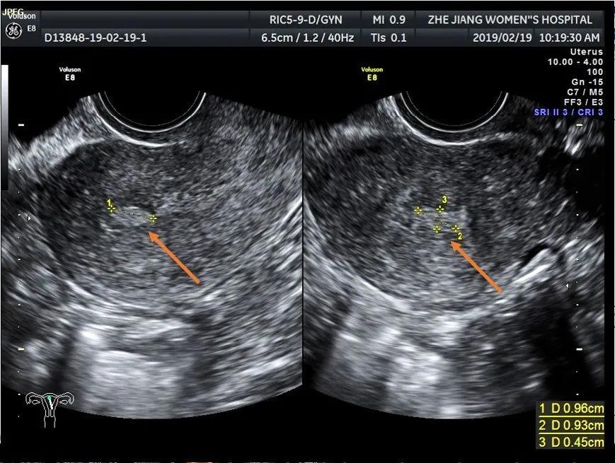 b超怎么显示子宫内膜息肉,b超发现子宫内膜息肉是癌症吗