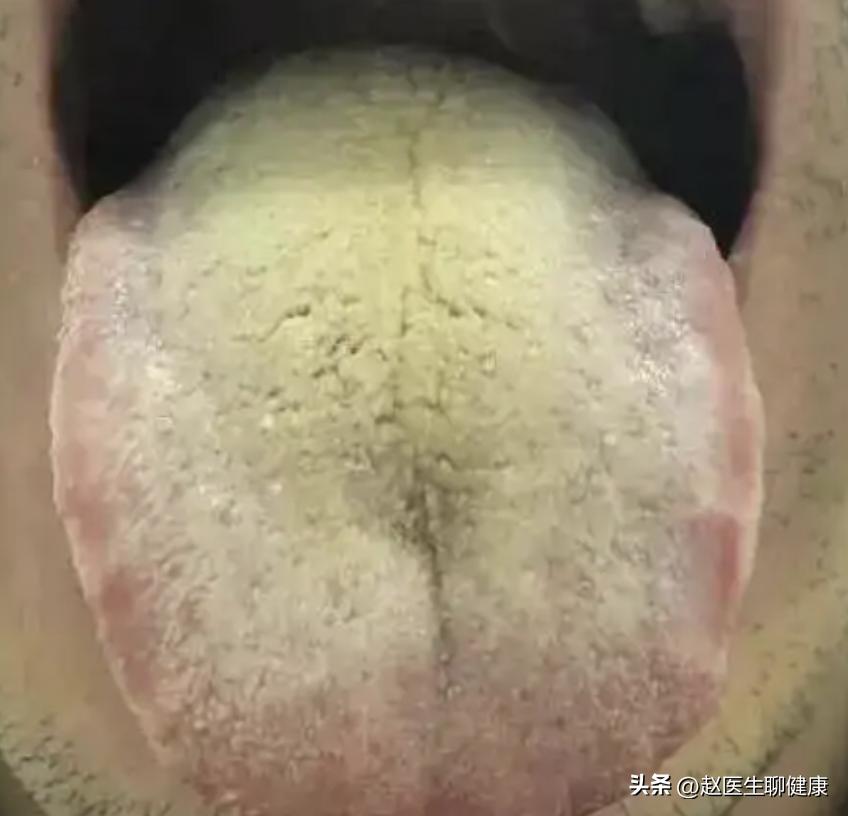 龙胆泻肝丸去肝火效果如何,龙胆泻肝丸对降肝火有用吗