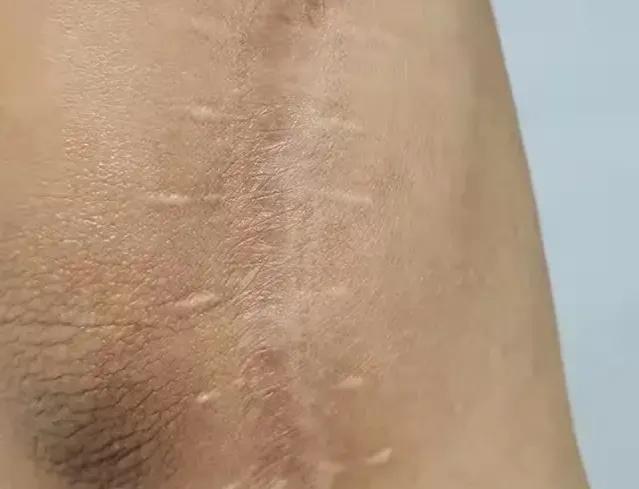 伤口缝合留疤还是不缝合留疤,可吸收的缝合线有疤痕吗