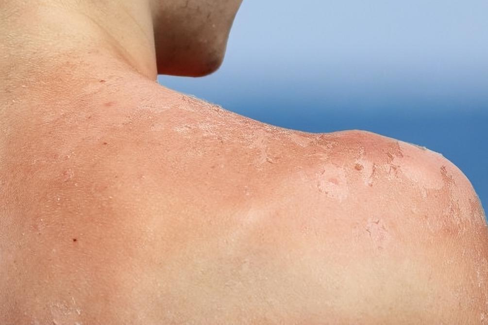 天天涂防晒霜还晒黑怎么回事,天天涂防晒感觉越来越黑