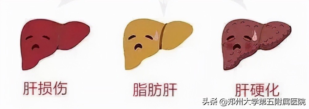 食管胃底静脉曲张破裂二次出血,胃底静脉曲张破裂出血致死