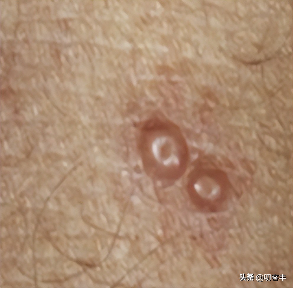 传染性软疣是hpv吗,传染性软疣的快问快答