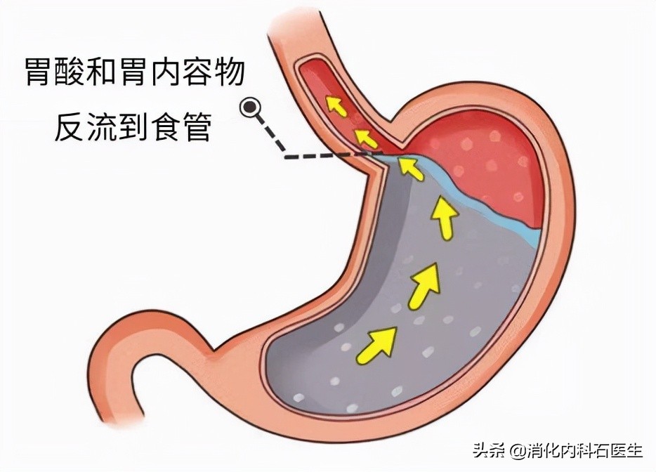 男子胸疼怀疑心梗实际胃病,男子胸痛挂急诊查出是胃病胸疼