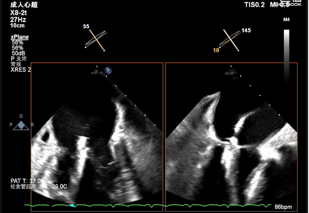 郑州大学第一附属医院心脏瓣膜,新技术治疗心脏瓣膜病