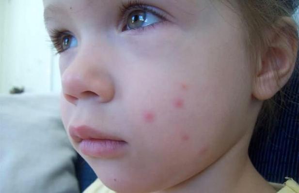 用炉甘石洗剂后可以用药吗,炉甘石是四类药品吗