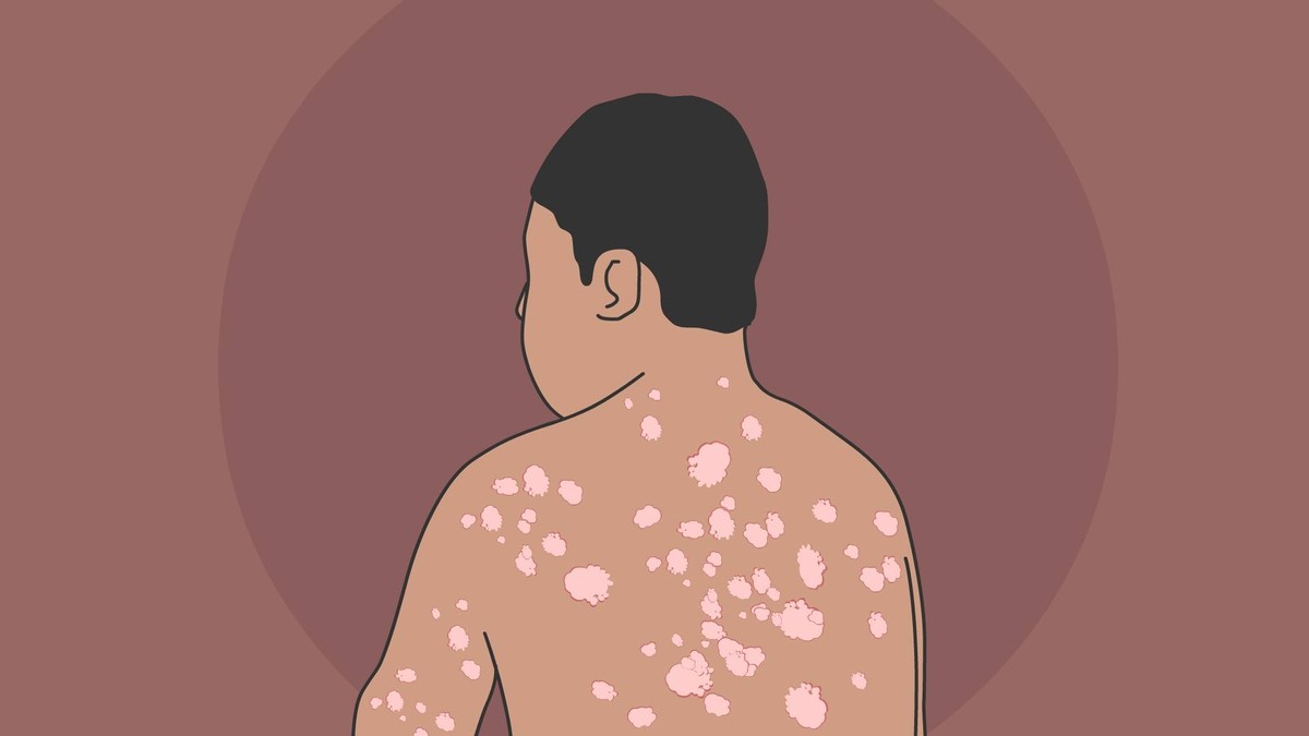 银屑病易与哪些皮肤病混淆,银屑病在人群中的比例