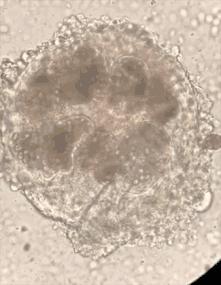 小男孩患虫癌,7岁男孩患虫癌