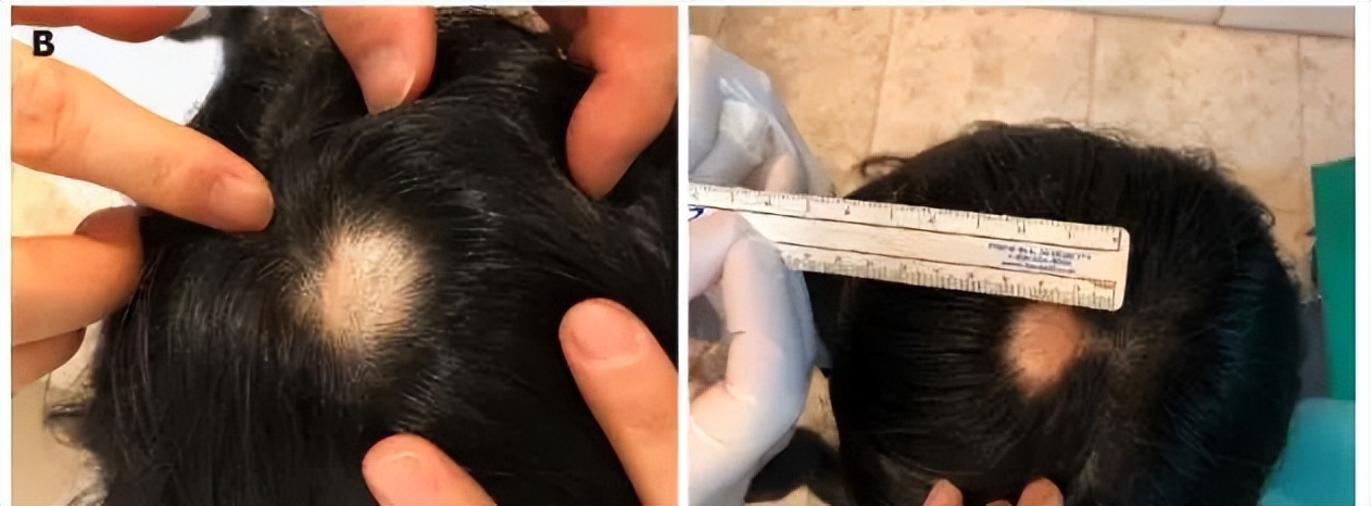 秃头康复,秃头可通过头疗生发吗