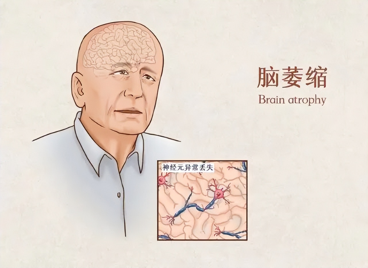 脑萎缩医生建议,害怕脑梗准备什么药物