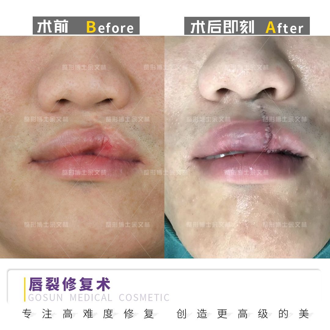 唇裂二期修复整容图片,唇裂科普视频