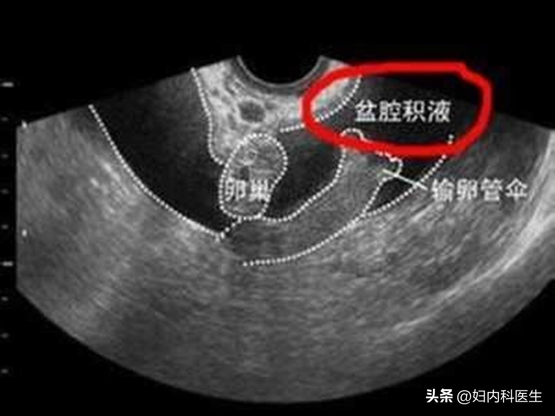 检查少量盆腔积液怎么办,患上盆腔积液能怎么办
