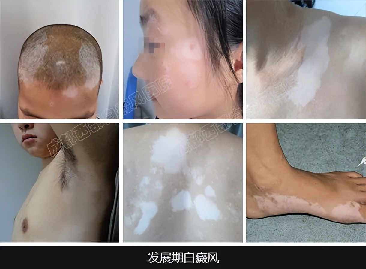 白癜风与伤口变白的区别,伤口变白斑是怎么回事