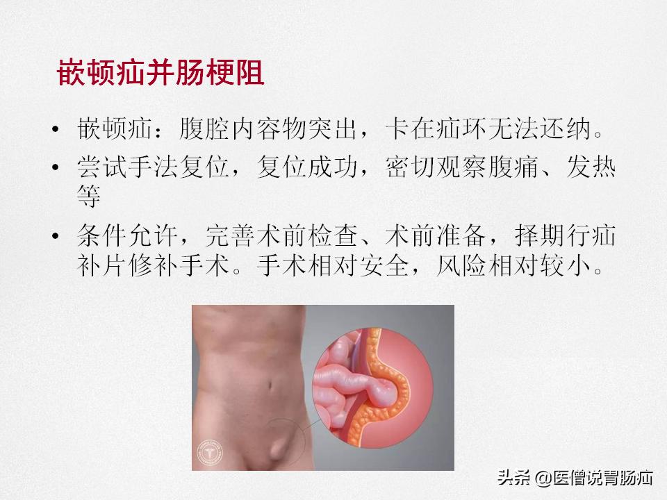 肠梗阻健康教育,肠梗阻患者的健康宣教