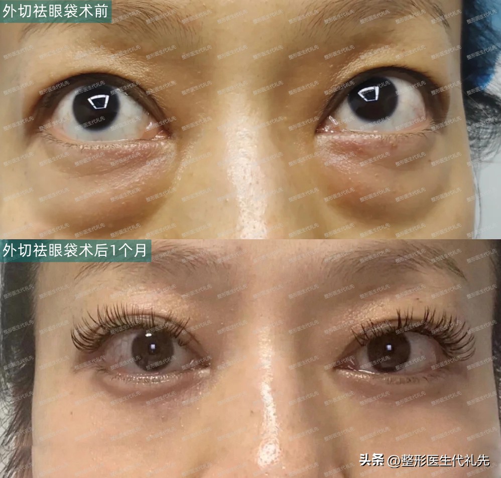 眼袋与卧蚕与泪沟的区别,做卧蚕跟眼袋的区别