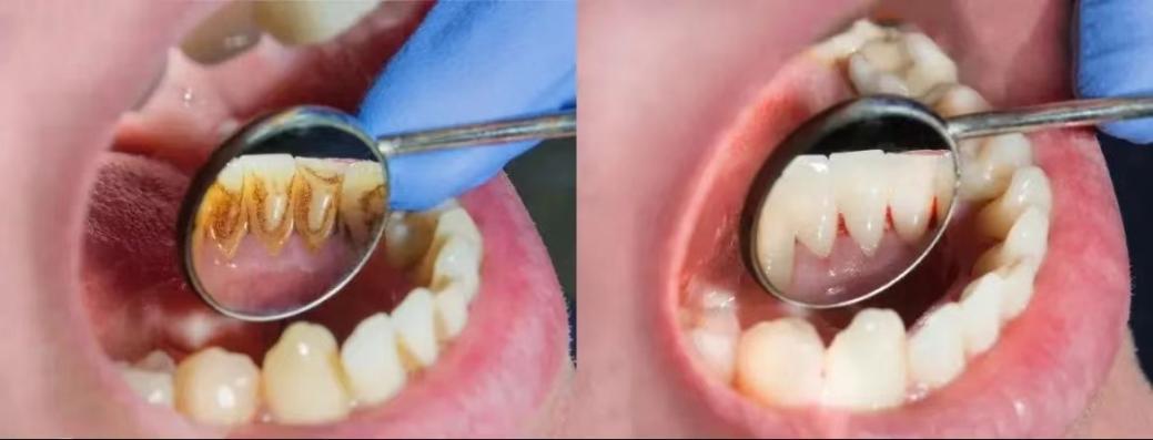 洗牙牙缝变大的原因和解决方法,牙缝特别小怎么洗牙