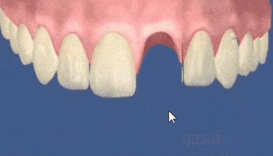 烤瓷牙什么情况要拆除,烤瓷牙崩瓷了要修复多少钱