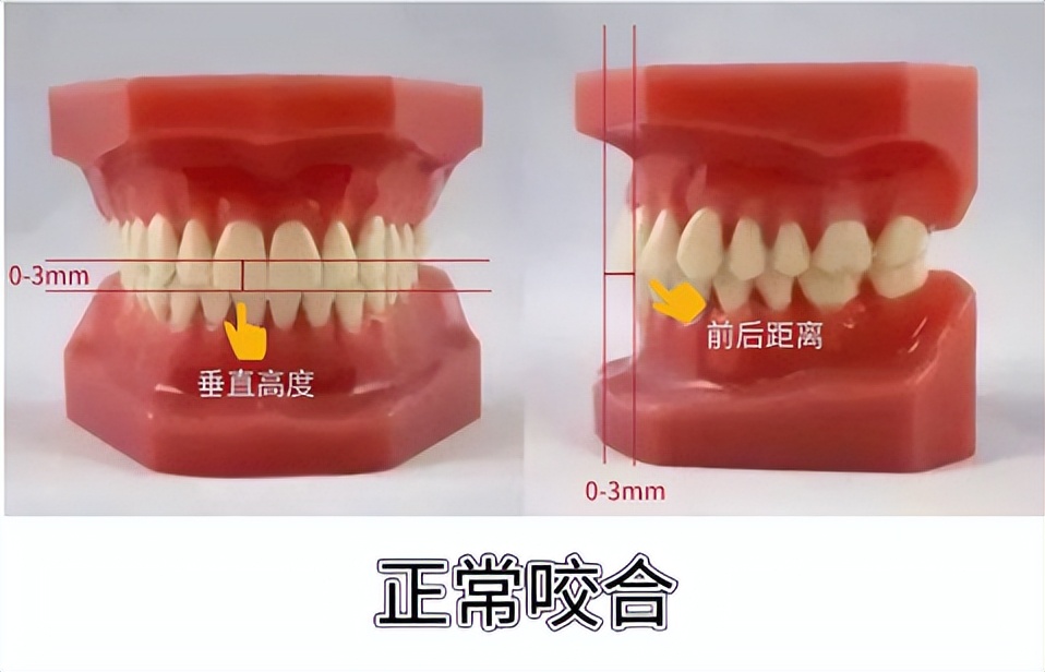 深覆颌深覆盖什么情况下不用矫正,深覆盖和深覆颌哪个严重些