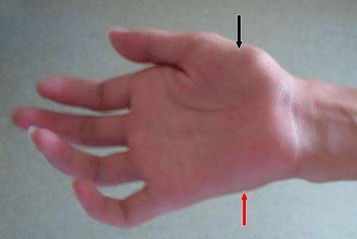 手腕无力手指笨拙虎口萎缩,手臂手掌无力萎缩的症状