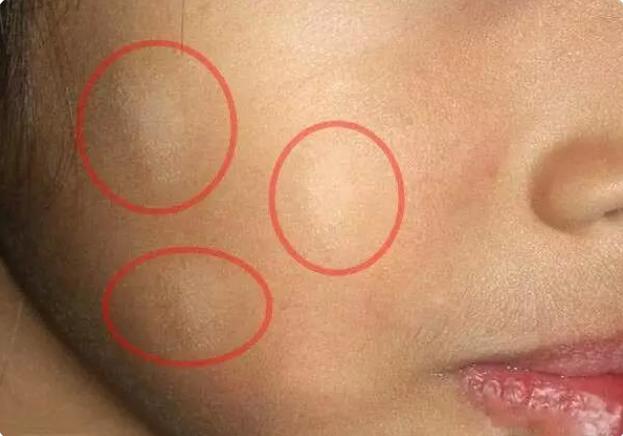 孩子脸上有白斑吃什么打虫药,小孩子脸上长白斑需要吃打虫药吗