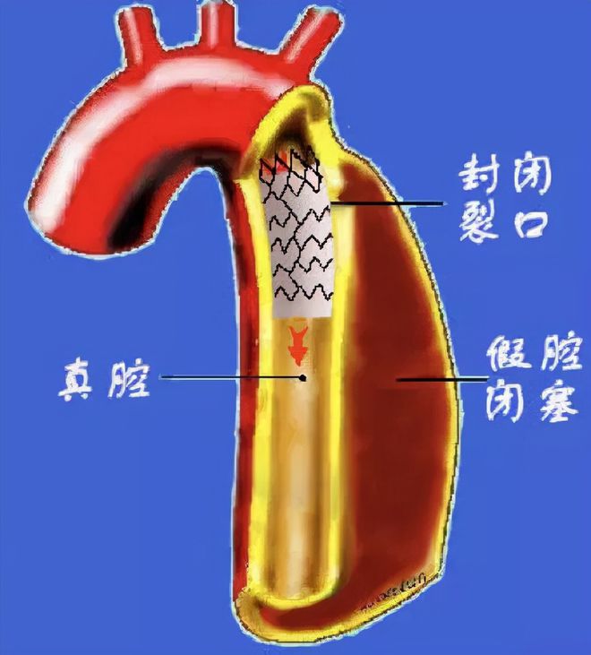大脑中动脉动脉瘤介入栓塞手术,大脑前动脉夹层手术